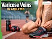 Varicose Veins In Athletes: Why Runners And Weightlifters Are At Risk? Warning Signs You Should Never Ignore
