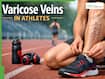 Varicose Veins In Athletes: Why Runners And Weightlifters Are At Risk? Warning Signs You Should Never Ignore
