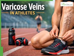 Varicose Veins In Athletes: Why Runners And Weightlifters Are At Risk? Warning Signs You Should Never Ignore