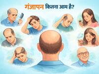 गंजापन कितना आम है? जानें पुरुष या महिला, किसे होता है ज्यादा हेयर फॉल