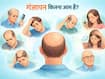 गंजापन कितना आम है? जानें पुरुष या महिला, किसे होता है ज्यादा हेयर फॉल