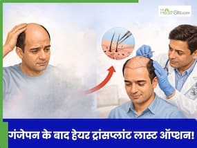 क्या पुरुषों में गंजेपन के बाद हेयर ट्रांसप्लांट ही आखिरी विकल्प है? जानें कब होता है यह जरूरी