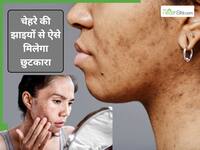 चेहरे पर पिगमेंटेशन क्यों हो जाती है? 3 नुस्खे दिलाएंगे झाइयों से छुटकारा