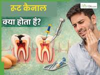 रूट कैनाल क्या होता है और कब पड़ती है इसकी जरूरत? जानें इसके बारे में