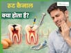 रूट कैनाल क्या होता है और कब पड़ती है इसकी जरूरत? जानें इसके बारे में