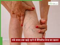 ज्यादा देर तक खड़े रहने से बढ़ रहा वैरिकोज वेन्स का खतरा, एक्सपर्ट ने बताया क्या है इलाज