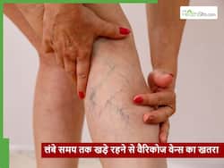ज्यादा देर तक खड़े रहने से बढ़ रहा वैरिकोज वेन्स का खतरा, एक्सपर्ट ने बताया क्या है इलाज
