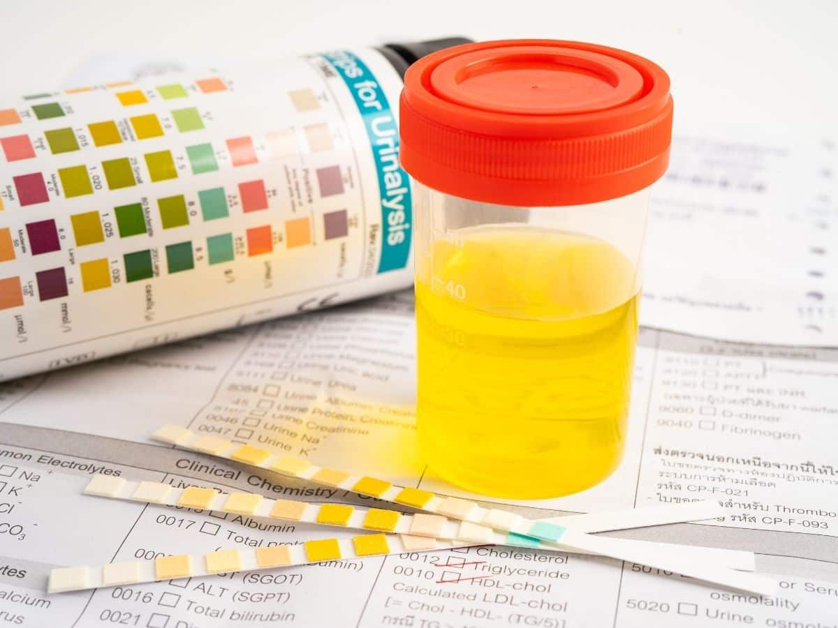 yellow urine