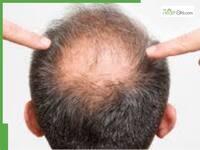 5 best natural hair growth oils for bald patches and hair regrowth