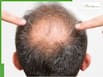 5 best natural hair growth oils for bald patches and hair regrowth