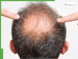5 best natural hair growth oils for bald patches and hair regrowth