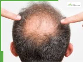 5 best natural hair growth oils for bald patches and hair regrowth