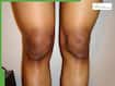 5 effective home remedies to get rid of dark knees naturally
