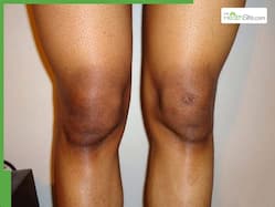 5 effective home remedies to get rid of dark knees naturally