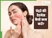 चेहरे की रेडनेस कम करने के लिए क्या लगाएं?