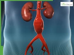 Aortic Arch Aneurysm: How Early Diagnosis And Minimally Invasive TEVAR Saved A 60-Year-Old Man   s Life