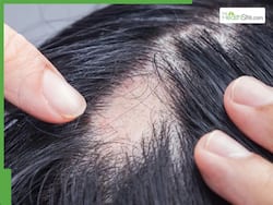 5 best oils to mix with castor oil for faster hair regrowth on bald patches