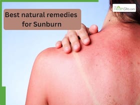 Best natural remedies for Sunburn : Here's how you can protect your skin this summer Best natural remedies for Sunburn : Here's how you can protect your skin this summer