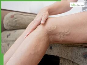 Chronic Venous Insufficiency: Early warning signs, causes, risk factors and effective treatment to prevent leg ulcers