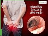 कोलन कैंसर का पहला स्टेज क्या है? डॉक्टर से जानिए इसके शुरुआती संकेत