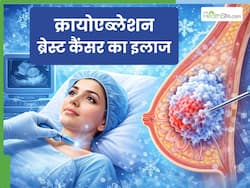 क्रायोएब्लेशन क्या है? जानें ब्रेस्ट कैंसर के इलाज में कैसे असरदार है यह सर्जरी
