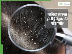 गर्मियों में डैंड्रफ क्यों होता है? जानें, बालों से रूसी हटाने के आसान तरीके