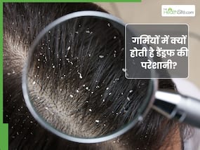 गर्मियों में डैंड्रफ क्यों होता है? जानें, बालों से रूसी हटाने के आसान तरीके