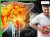 Fatty liver without alcohol? Expert explains why NAFLD is increasing among non-drinkers