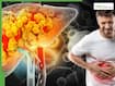 Fatty liver without alcohol? Expert explains why NAFLD is increasing among non-drinkers