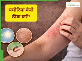 Summer Skin Care Guide: गर्मियों में खुजली, रैशेज और घमौरियां क्यों हो जाती हैं? काम आएंगे ये 3 घरेलू उपाय