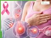 Hereditary cancer risk in women: How BRCA gene mutations increase breast and ovarian cancer risk