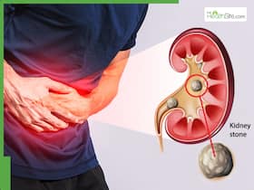 Kidney Stones: Causes, symptoms, treatment and prevention tips to avoid serious kidney damage