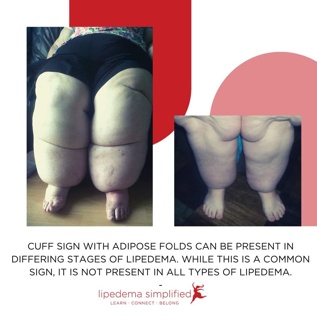 Lipedema