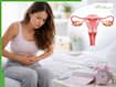 PCOS in young women: Why it’s rising in your 20s? Know early symptoms and ways to manage