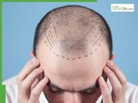 5 best natural hair growth oils for men with receding hairline