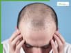 5 best natural hair growth oils for men with receding hairline