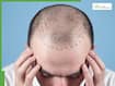 5 best natural hair growth oils for men with receding hairline