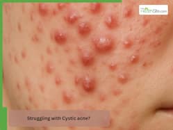 Struggling with Cystic acne? Here   s everything you need to know