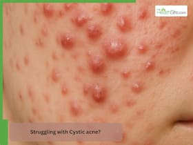 Struggling with Cystic acne? Here   s everything you need to know