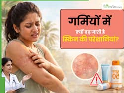 गर्मियों में क्यों बढ़ने लग जाती हैं स्किन की परेशानियां? डर्मेटोलॉजिस्ट से जानें बचाव के तरीके