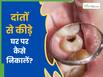 दांत में लगे कीड़े को कैसे हटाएं? जाने 5 तरीके, जिनसे कैविटी भी होगी खत्म