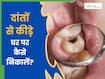 दांत में लगे कीड़े को कैसे हटाएं? जाने 5 तरीके, जिनसे कैविटी भी होगी खत्म