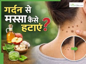 गर्दन पर मस्से हो जाए तो क्या करें? जानें 5 नुस्खे,  जिनसे साफ हो सकती है स्किन