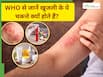 एक्जिमा क्या होता है? WHO ने शेयर की रिपोर्ट, बताए लक्षण-कारण और उपाय