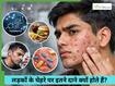 लड़कों के गाल पर ज्यादा पिंपल्स क्यों होते हैं?
