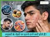 लड़कों के गाल पर ज्यादा पिंपल्स क्यों होते हैं?