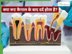 RCT के बाद दांतों में तेज दर्द से हैं परेशान? तो घबराएं नहीं, अपनाएं ये उपाय और जानें कब डॉक्टर को दिखाएं