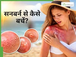 Sunburn Treatment: अभी से जलने लगी है धूप से त्वचा? इन 5 तरीकों से करें ठीक