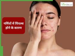 गर्मियों में क्यों ज्यादा होते हैं पिंपल्स और एक्ने? डॉ. विनय ने बताई इसकी 5 वजह