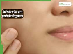 त्वचा के सफेद दाग को दूर करने के लिए अपनाएं ये 3 घरेलू नुस्खें